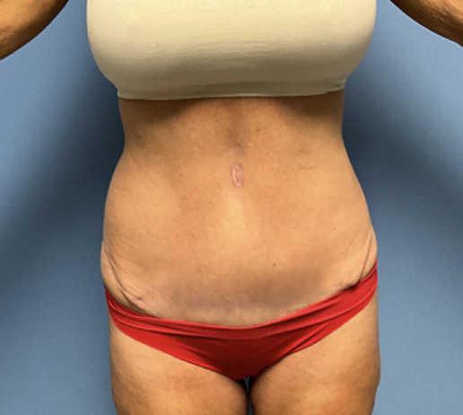 Tummy-Tuck--Case-Study-2907 | After Body